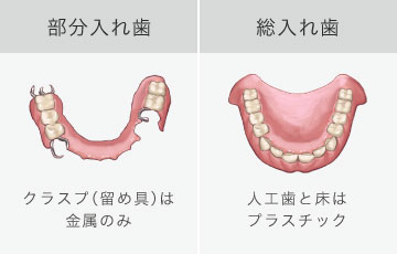 部分入れ歯：クラスプ（留め具）は金属のみ、総入れ歯：人工歯と床はプラスチック